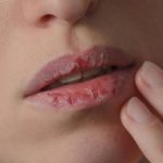 peeling skin on the lips
